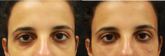 27-year-old female patient treated with Belotero for under eyes.