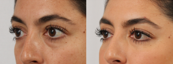 1 week difference of Belotero treatment for dark circles and bags under eyes.