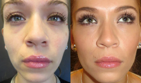32-year-old Belotero patient who received fillers for under eye hollows.