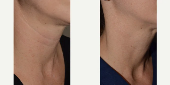 Before and after comparison of using Belotero to treat necklines.