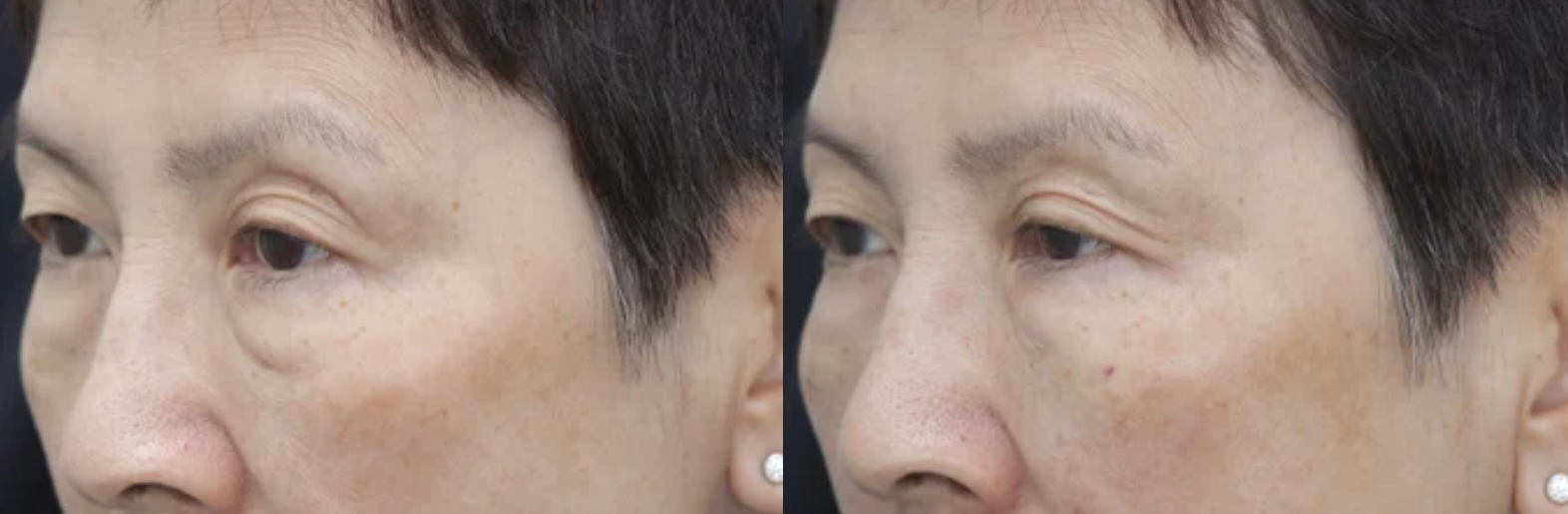 64-year-old woman receives Belotero fillers to address volume loss.