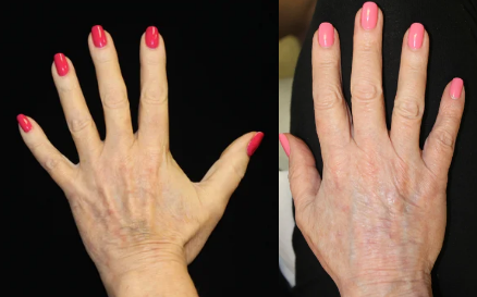 Belotero treatment applied to hands.