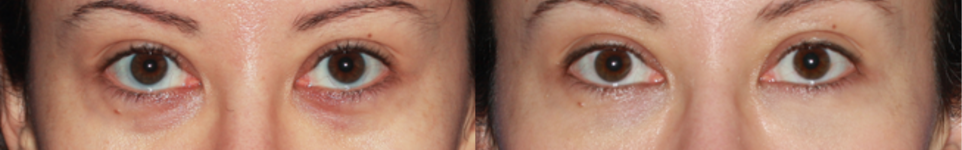 Female patient's before-and-after photos of Belotero treatment.